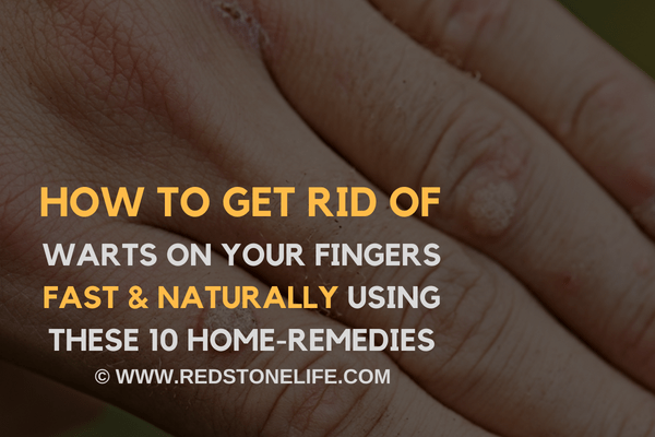 How To Get Rid Of Warts On Your Fingers FAST & Naturally - (10 Home Remedies) - redstonelife.com