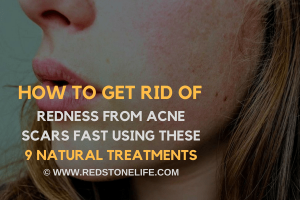 How to Get Rid of Redness from Acne Scars FAST USING these 9 NATURAL Treatments - redstonelife.com