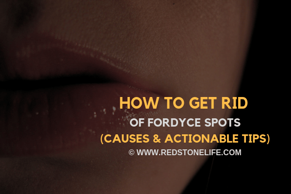 How to get Rid Of Fordyce Spots - (Causes & Actionable Tips) - Redstonelife.com