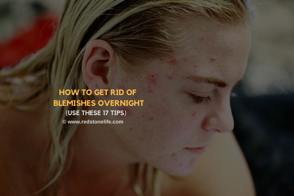 How to Get Rid of Blemishes Overnight: (Use These 17 Tips) - redstonelife.com