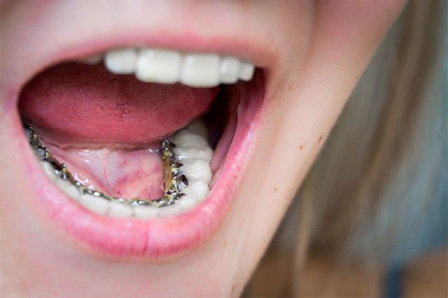 Lingual / incognito braces