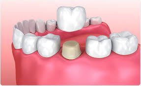 Restorative crowns