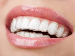 How to make your teeth straighter without braces: Invisalign method